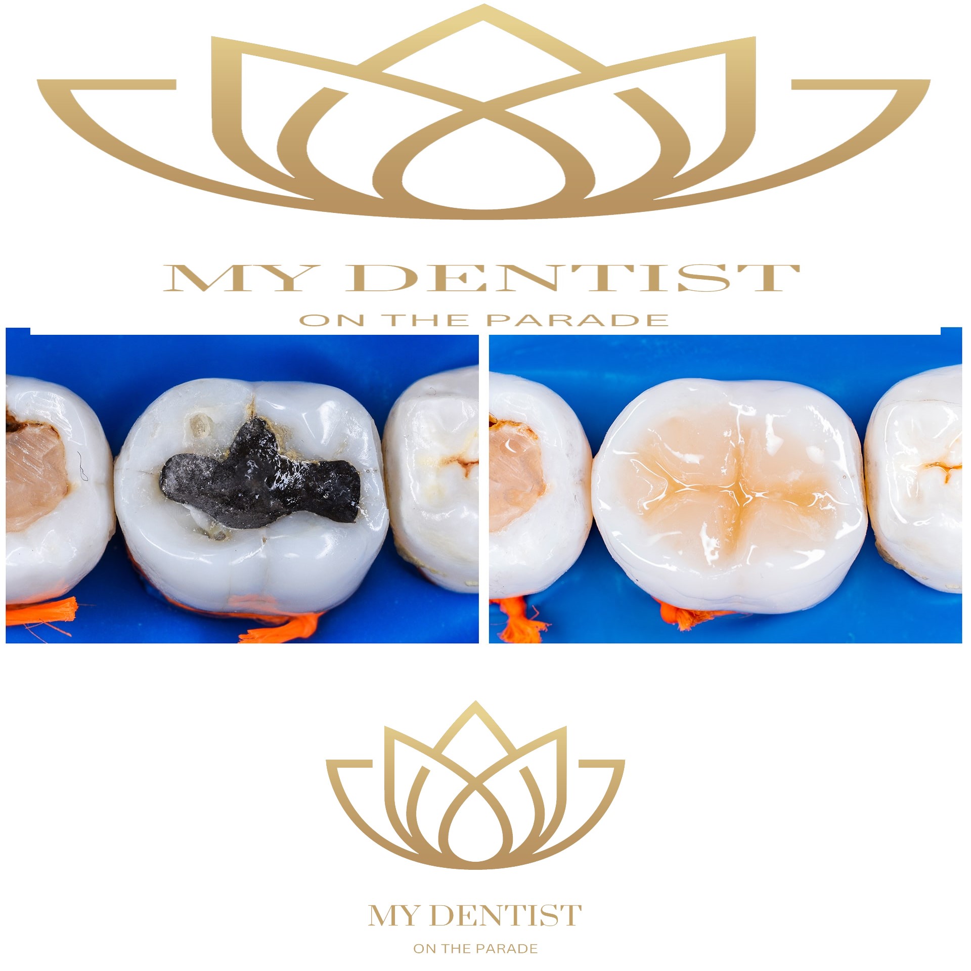 Dental Crowns Adelaide